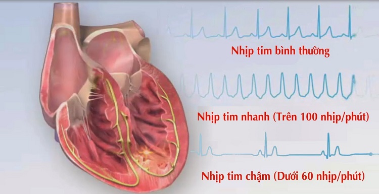 RỐI LOẠN NHỊP TIM – NGUYÊN NHÂN CỦA 80% TRƯỜNG HỢP ĐỘT TỬ 1