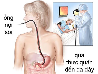 Xét nghiệm phát hiện vi khuẩn Hp