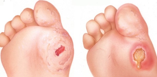 CÁCH CHĂM SÓC BÀN CHÂN ĐÁI THÁO ĐƯỜNG: 10 NGUYÊN TẮC CẦN NHỚ