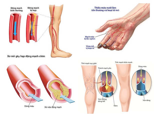 BỆNH MẠCH MÁU NGOẠI BIÊN: ĐỪNG CHỦ QUAN VỚI NHỮNG DIỄN TIẾN “ÂM THẦM”