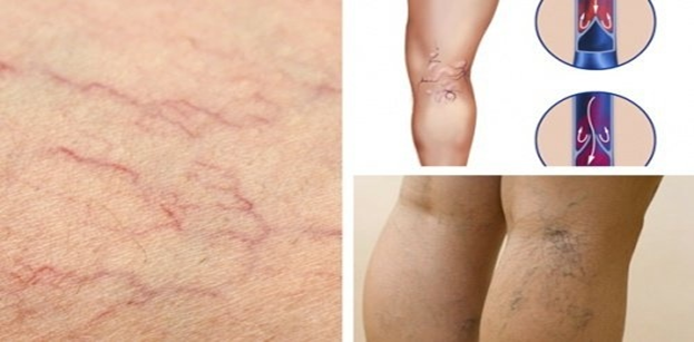 SUY GIÃN TĨNH MẠCH NỖI LO CỦA DÂN VĂN PHÒNG VÀ NGƯỜI LỚN TUỔI