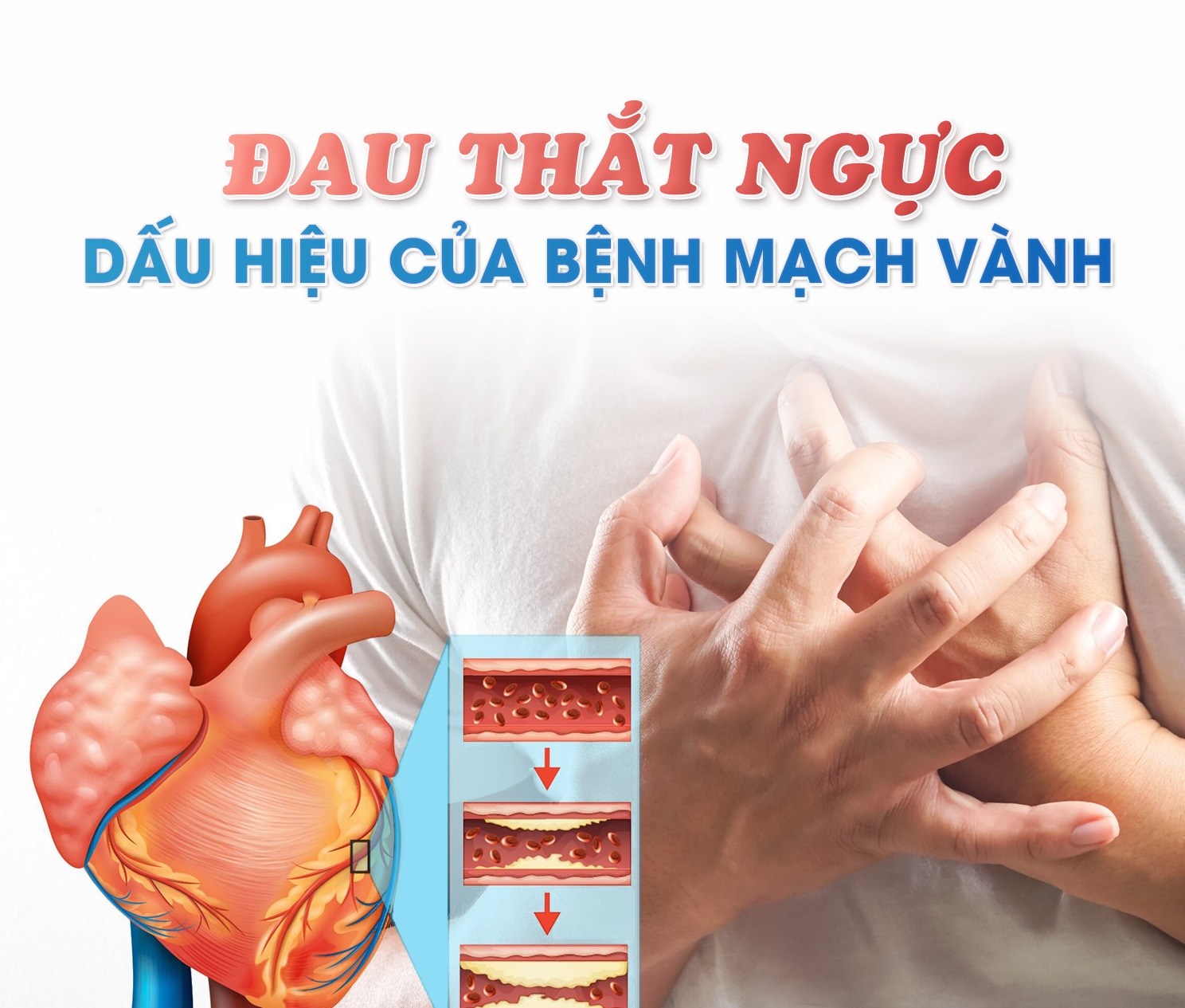 ĐAU THẮT NGỰC: Dấu hiệu CẢNH BÁO Bệnh Mạch Vành