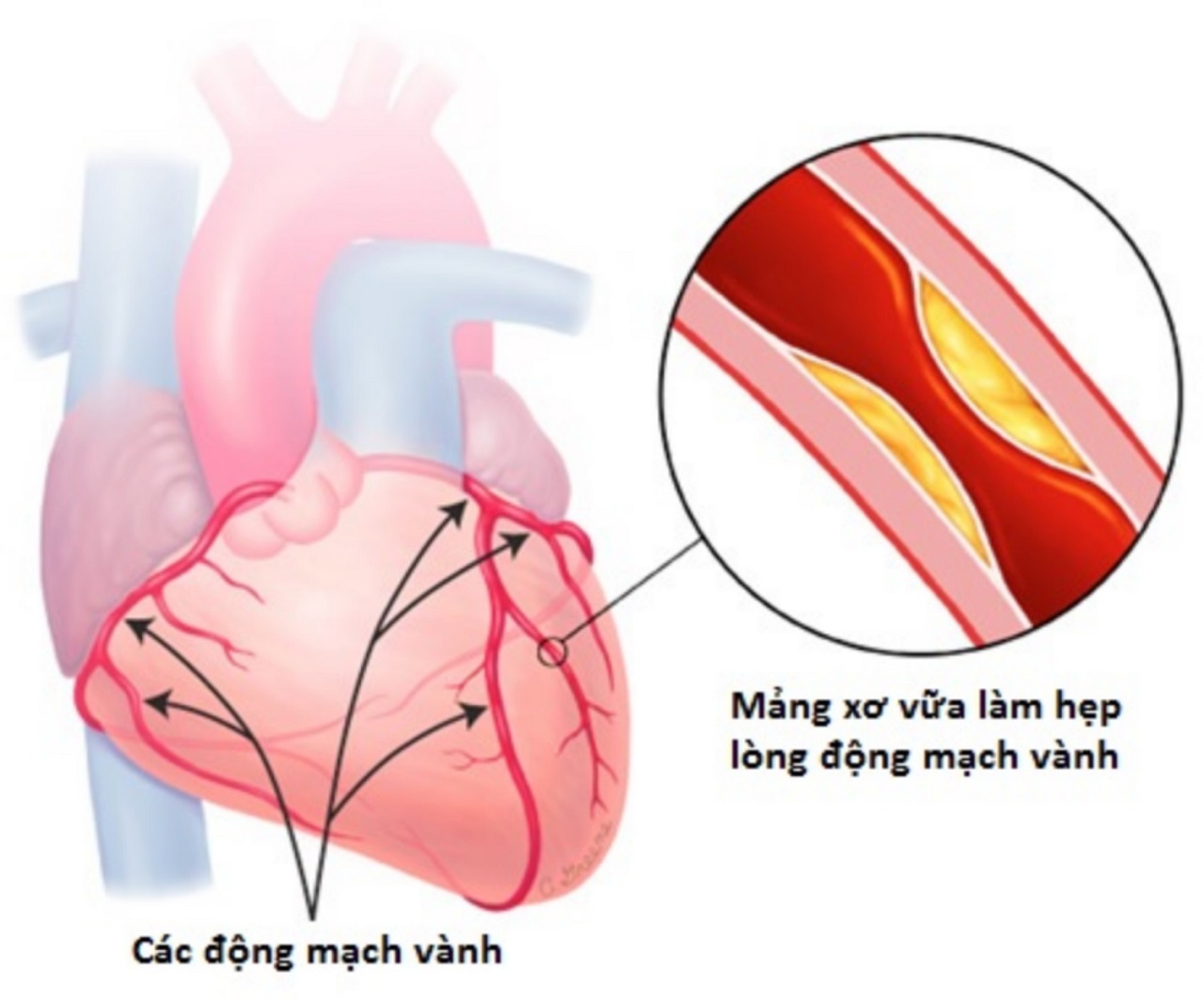 Ngừa BỆNH MẠCH VÀNH bằng cách nào ???
