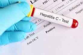 HCV RNA