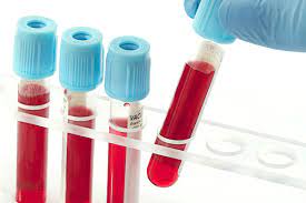 Anti Cardiolipin (IgM + IgG)