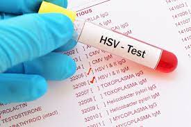 Herpes (IgM + IgG)