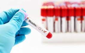 Measles (IgM + IgG) (Sởi)