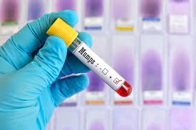 Mumps (IgM + IgG) (Quai bị)