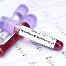 Varicella Zoster (IgM + IgG) (Thủy đậu)