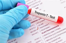 Men tim (Troponin T-hs, CK-MB)