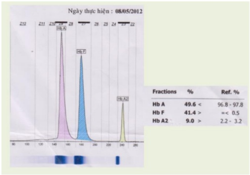 Điện di Hemoglobin